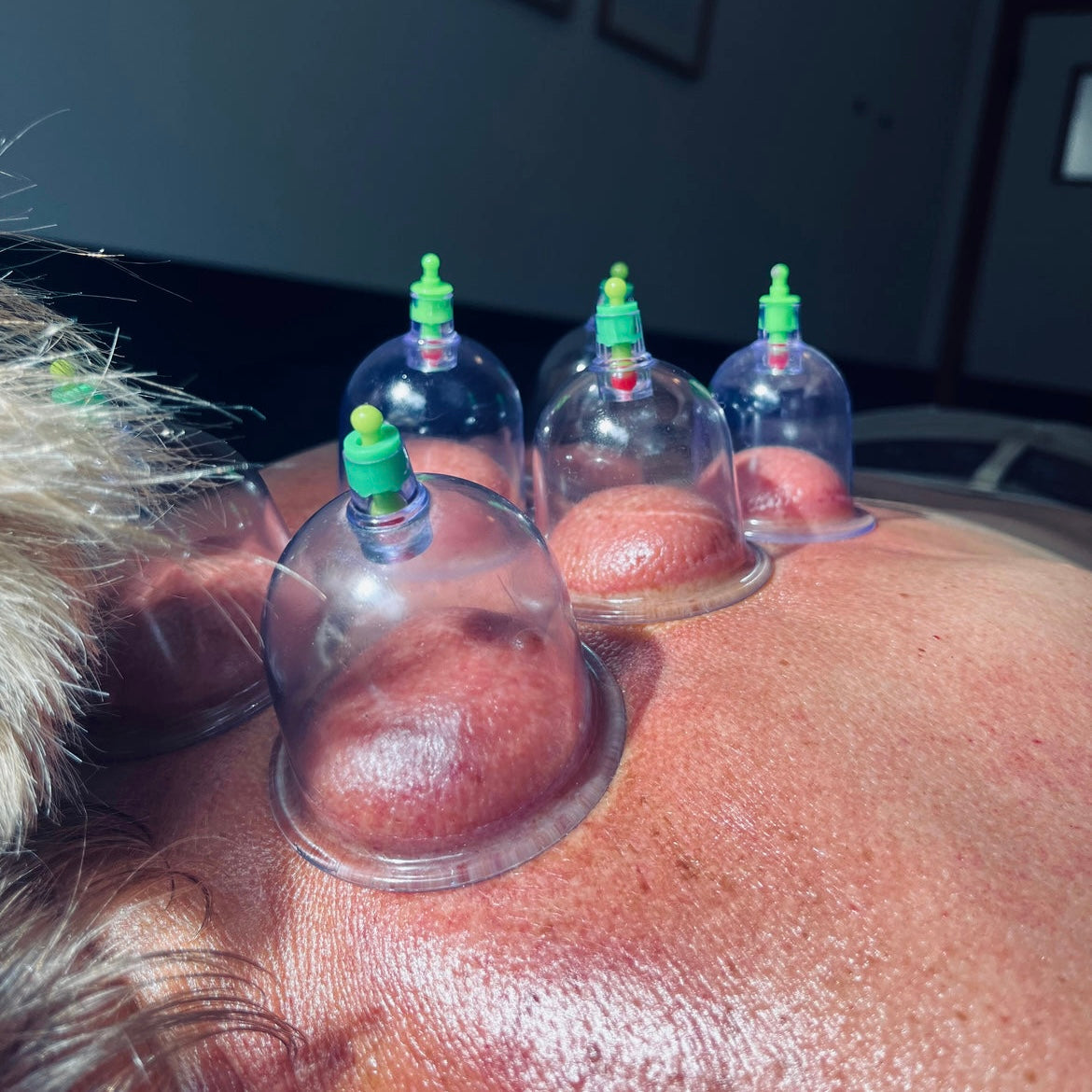 CUPPING MASSAGE